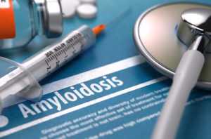 Лечение амилоидоза