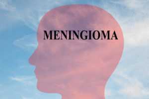 Лечение менингиомы